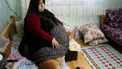 Sakarya ’da yaşayan ve 250 kilo olan Sevim Bal obezite operasyonu ile 95 kiloya düştü